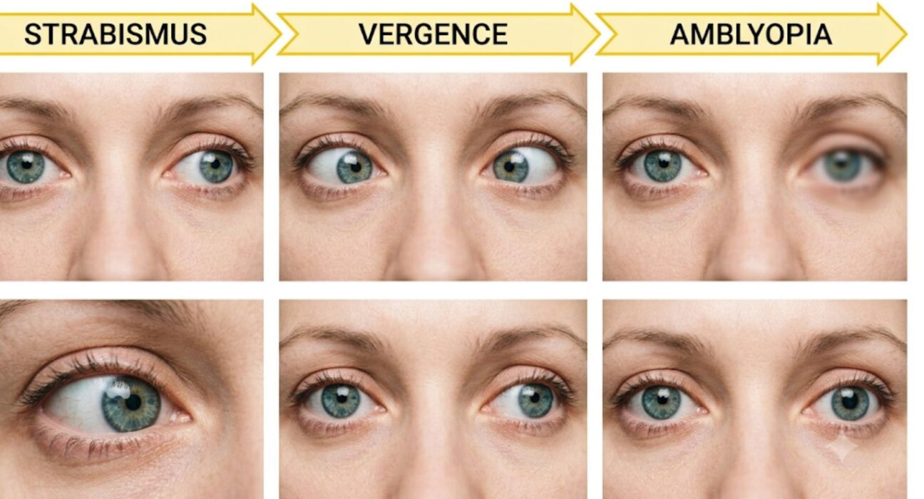 Binocular Vision Dysfunction types and eye alignment chart